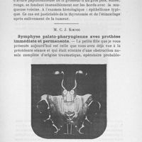 0055 - Page 53 - M. C. J. Koenig : Symphyse palato-pharyngienne avec prothèse immédiate et permanente