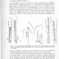 0122 - Page 118 - Analyses. Neuropathologie. Sur un cas de perversion de la localisation des sensations ou allachaesthésie (A clinical lecture on a case of perverted localisation of sensation or allachaestesia), par Grainger Stewart. The British medical Journal...
