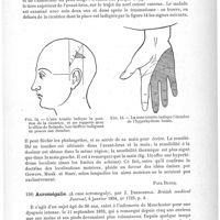 0177 - Page 173 - Analyses. Neuropathologie. Monoplégie brachiale droite, et paresthésie due à l'ablation traumatique de l'aire brachiale de l'écorce de l'hémisphère cérébral gauche : guérison (Right brachial monoplegia, and perverted sensations, due to traumatic ablation of the arm area in the left cortex cerebri ; recovery), par J. Lynn Thomas. British medical Journal... / Acromégalie (A case acromegaly), par J. Dreschfeld. British medical Journal...