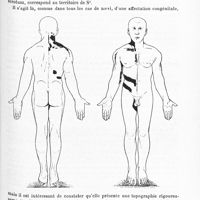 0611 - Page 607 - Société de neurologie de Paris. Séance du 1er décembre 1910. VIII. Naevi à topographie radiculaire chez un enfant de 5 ans, par MM. P. Armand-Delille et L. Lagane (Présentation du malade) / IX. Hémianesthésie chez les aphasiques, par MM. Pierre Marie et Foix...