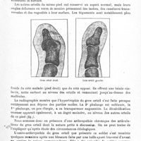 0073 - Page 73 - Société de neurologie de Paris. Séance du 7 février 1918. Communications et présentations. II. Ostéo-arthropathie chronique des orteils et aréflexie chez un blessé de guerre (présentation d'un malade), par M. Henri Français...