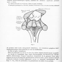 0144 - Page 84 - Société de neurologie de Paris. Séance du 5 janvier 1928. Addendum à la séance précédente. Tuberculome des tubercules quadrijumeaux gauches, par L. Caussade, L. Cornil et J. Girard / Crises hypertoniques de décérébration à prédominance droite. - Porencéphalie rolandique gauche, par L. Cornil, L. Caussade et J. Girard