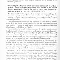0600 - Page 540 - Société de neurologie de Paris. Séance du 29 mars 1928. Communications et présentations. Syndrome choréique chronique à topographie brachio-cervico-faciale avec dysarthrie de type wilsonien, précédé, il y a trente ans, d'une crampe des écrivains et il y a vingt ans d'un torticolis spasmodique, par Alajouanine, Thurel et Gopcevitch / Cheiromégalie du gros orteil avec mal perforant et arthropathie métatarso-phalangienne, au cours d'un tabes fruste développé, à l'âge de 40 ans, chez une hérédo-syphilitique par Alajouanine, Bascourret et Ducas