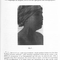 0416 - Page 353 - Société de neurologie de Paris. Séance du 5 mars 1931. Deux cas d'anomalies d'ossification de la colonne cervicale avec troubles nerveux consécutifs, par M. C.-I. Urechia