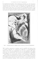 Fig. 3. Dissection montrant la bandelette optique, le pulvinar et la section de l'hémipédoncule - Re [...]