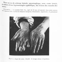 1465 - Page 1405 - Société de neurologie de Paris. Séance du 2 juin 1932. Les résultats de la malariathérapie dans la syphilis nerveuse durant la période de 1925 à 1931 inclus, par M. D. Paulian... / Sclérose latérale amyotrophique associée à une trichinose latente, par MM. D. Paulian et T. Paunesco...