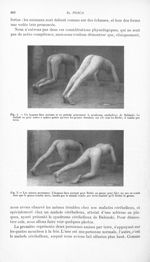 Fig. 1. Un homme bien portant et un malade présentant le syndrome cérébelleux de Babinski / Fig. 2.  [...]