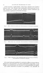 Fig. 4. Réflexe rotulien chez un sujet normal (électromyogramme et mécanogramme superposés) / Fig. 5 [...]