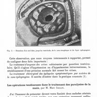 0626 - Page 584 - Société de neurologie de Paris. Séance du 6 novembre 1941. Le traitement neurochirurgical de l'épilepsie (intérêt des examens électro-biologiques), par MM. Pierre Puech et Jacques Porin / Les opérations tendineuses dans le traitement des paralysies de la main, par M. Marc Iselin