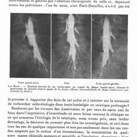 0634 - Page 592 - Société de neurologie de Paris. Séance du 6 novembre 1941. Radiodiagnostic de la sciatique (après remplissage lipiodolé du cul-de-sac lombo-sacré et des gaines des racines), par MM. Th. Alajouanine, R. Thurel et H. Welti