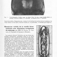 0063 - Page 33 - Société de neurologie de Paris. Séance du 4 février 1943. Un cas de cinquième ventricule, par MM. M. David, H. Hecaen et J. Héry (Résumé) / Hématome calcifié de la moelle dorso-lombaire avec dilatations variqueuses de voisinage, par MM. M. David, E. Carrot, J. Paraire et Charlin (Résumé)