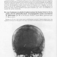 0188 - Page 158 - Société de neurologie de Paris. Séance du 10 juin 1943. Deux cas de maladie de Recklinghausen avec neurinomes intracraniens et intrathoraciques, par MM. Th. Alajouanine, R. Thurel, G. Richet et J. Nehlil / Un cas d'ostéome ou plutôt d'endocraniose du frontal droit et de la petite aile du sphénoïde droit, accompagné de crises convulsives et délirantes, par M. le Dr Daniel Ferey... (présenté par P. Mollaret)