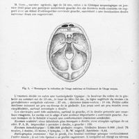 0318 - Page 288 - Société de neurologie de Paris. Séance du 4 novembre 1943. Essai de classification des tumeurs cérébrales, par MM. J.-E. Paillas et H. Gastaut... / Etude anatomo-clinique d'une oxycéphalie, par MM. H. Roger, J. F. Paillas, P. Guillot, P. Mouren...