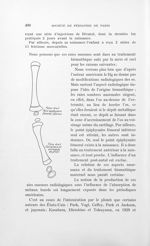 [Modifications de l’aspect radiologique des os chez un nourrisson de 2 mois dont la mère a reçu pend [...]