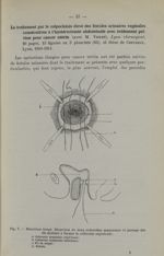 Fig. 7. - Deuxième temps. Dissection de deux collerettes muqueuses et passage des fils destinés à fe [...]