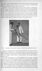 Fig. 1. Asynergie. Attitude pendant la marche, le malade étant soutenu par deux aides - Quelques doc [...]