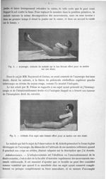 Fig. 4. Asynergie. Attitude du malade sur le dos faisant effort pour se mettre sur son séant/ Fig. 5 [...]