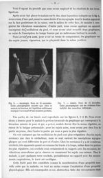 Fig. 6. Asynergie. Pose de 15 secondes. Cette photographie montre que chez ce malade la fonction de  [...]