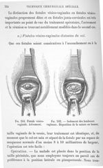 Fig. 247. Avivement du col et dissection des lambeaux vaginaux / Fig. 248. Fermeture de l'orifice va [...]