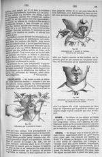 Fig. 258. Chiloplastie par le procédé de Chopart / Fig. 259. Chiloplastie par le procédé de Lisfranc [...]