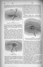 Fig. 753. Dissection de la peau pour découvrir l'artère / Fig. 754. Isolement de l'artère / Fig. 755 [...]