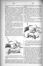 Fig. 835. Extirpation de la mamelle (premier temps) / Fig. 836. Extirpation de la mamelle (second te [...]