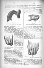 Fig. 971. Ongle du gros orteil hypertrophié ayant acquis un accroissement excessif / Fig. 972. Posit [...]