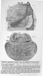 Dégénérations consécutives à une lésion bulbaire (cas de Babinski et Nageotte). Méthode de Marchi; c [...]