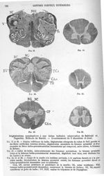 Dégénérations consécutives à une lésion bulbaire (observation de Babinski et Nageotte). Méthode de M [...]