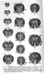 Fig. 64. Dégénération de la queue de cheval consécutive à un noyau de cancer secondaire du rachis (P [...]