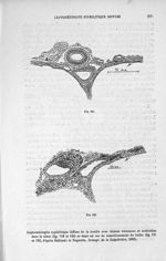 Fig. 121. 122. Leptoméningite syphilitique dans un cas de ramollissement de bulbe. D'après Babinski  [...]