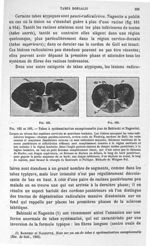 Fig. 165 et 166. Tabes à systématisation exceptionnelle (cas de Babinski et Nageotte). - Manuel d'hi [...]