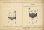 Fig. 241. - Compression de l'utérus et des ovaires. Fig. 242. - Grossesse - Nouveau recueil des appa [...]