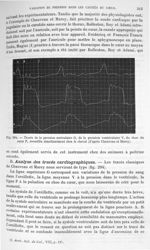 Fig. 294. Tracés de la pression auriculaire, de la pression ventriculaire, du choc du cœur, recueill [...]