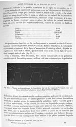 Fig. 312. Tracés cardiographiques de l'oreillette et du ventricule droits chez une femme atteinte d' [...]