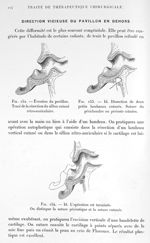 Fig. 152. Eversion du pavillon. Tracé de la résection du sillon cutané rétro-auriculaire / Fig. 153. [...]