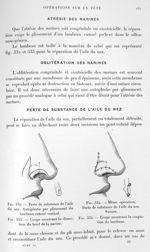 Fig. 332. Perte de substance de l'aile du nez. Autoplastie par glissement du lambeau cutané vertical [...]