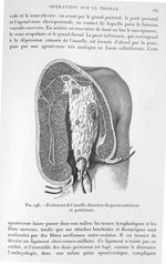 Fig. 296. Evidement de l'aisselle, dissection des parois antérieure et postérieure. - Traité de thér [...]