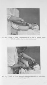 Fig. 458. Idem. 3e temps. Commencement de la taille du lambeau cutané deltoïdien, le bras étant en a [...]