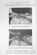 Fig. 502. Résection du coude. 1er temps. Incision longitudinale postérieure. Découverte du tendon tr [...]