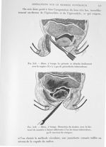 Fig. 515. Idem. 2e temps. Le périoste se détache facilement avec la rugine s'il n'y a pas de périart [...]