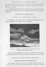 Fig. 547. Dissection et allongement des tendons de la main adhérents à une cicatrice vicieuse. - Tra [...]