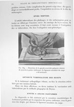 Fig. 569. Dissection de la grande synoviale palmaire atteinte de synovite à grains riziformes. Le li [...]