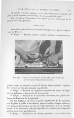 Fig. 570. Idem. La synoviale est incisée et les grains riziformes ont été évacués. Dissection des te [...]