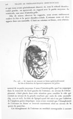 Fig. 223. Id. Aspect de cet estomac en bissac après soulèvement du foie et dissection du ligament su [...]