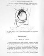 Fig. 225. Dilatation considérable de l'estomac et dissection du ligament suspenseur du pylore (d'apr [...]