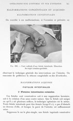 Fig. 386. Cure radicale d'une fistule intestinale. Dissection du trajet intestino-pariétale. - Trait [...]