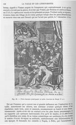 Fig. 82. Frère Jacques pratiquant la taille. -  Encyclopédie française d'urologie, publiée sous la d [...]