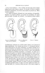 Fig. 20. Procédé de Nélaton. Tracé du lambeau / Fig. 21. Dissection du lambeau / Fig. 22. Sutures -  [...]