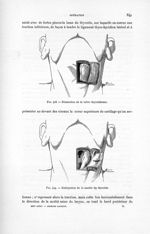 Fig. 418. Dissection de la valve thyroïdienne / Fig. 419. Extirpation de la moitié du thyroïde - Chi [...]